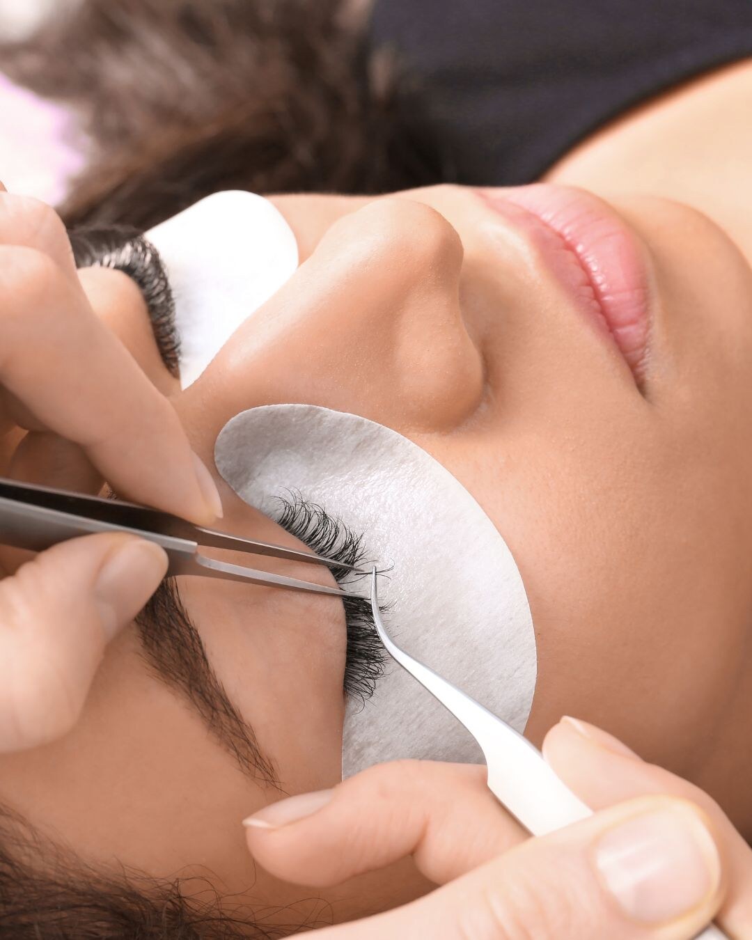 Behandlungsergebnis im Prestige Beautypoint