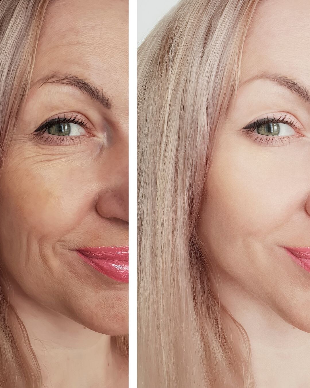 Behandlungsergebnis im Prestige Beautypoint